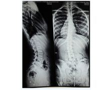矫形器脊柱侧弯2